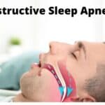 Obstructive Sleep Apnea