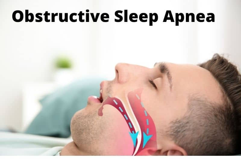 Obstructive Sleep Apnea