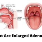 What Are Enlarged Adenoids?