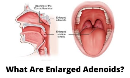 What Are Enlarged Adenoids?