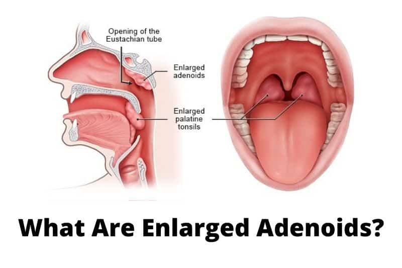 What Are Enlarged Adenoids