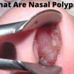 What Are Nasal Polyps?