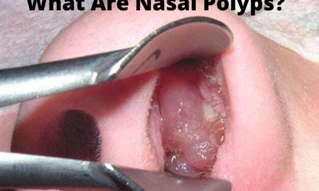 What Are Nasal Polyps?