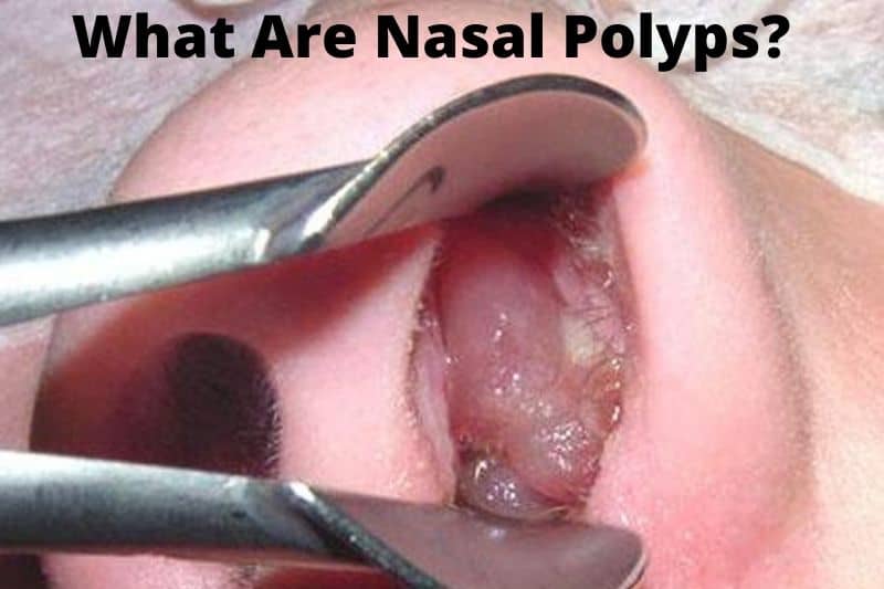 What Are Nasal Polyps