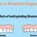 What Is Bruxism Diagnosis?