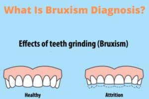 What Is Bruxism Diagnosis